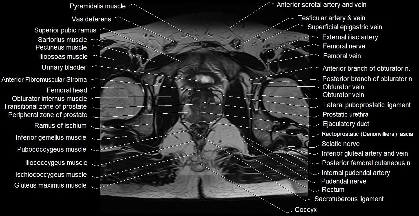 Male pelvis axial cross sectional anatomy image 32.webp